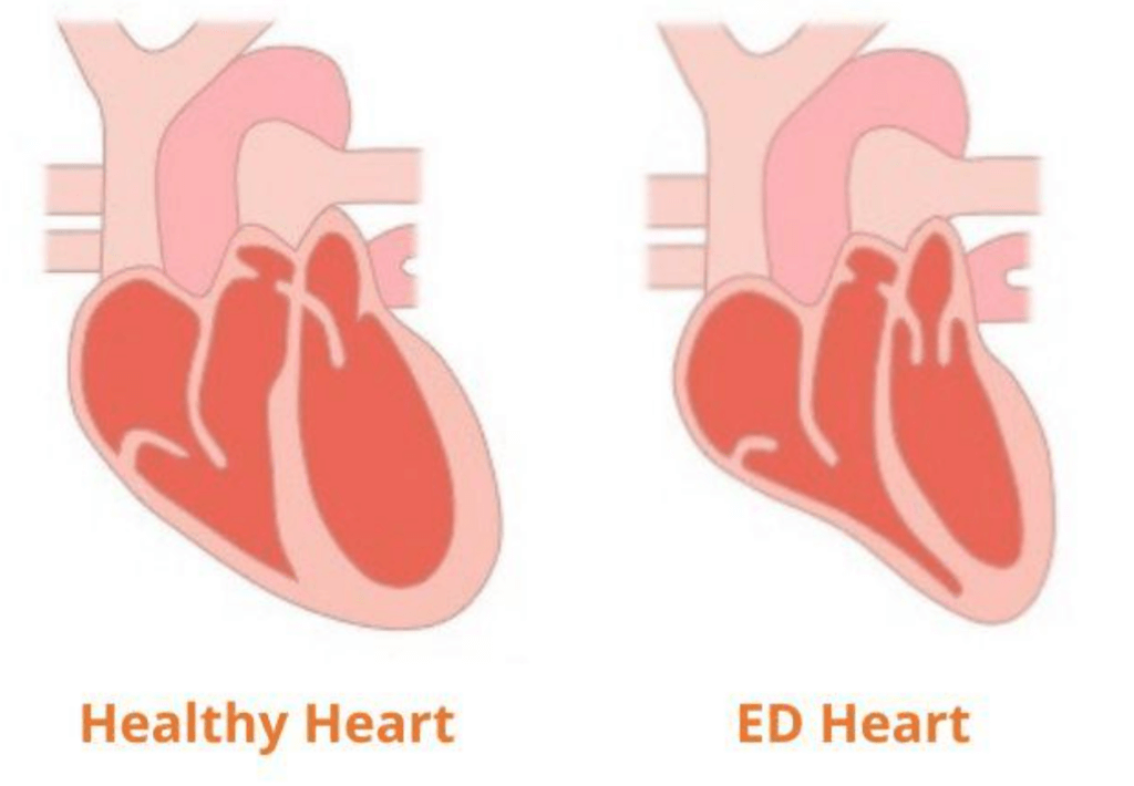 Image of two hearts with text below one on the left that reads, "healthy heart" and one on the right reads, "ED heart". ED hard is smaller than the healthy heart.